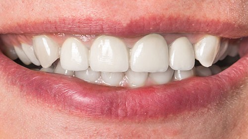 Dentures Problems Lincoln NE 68508